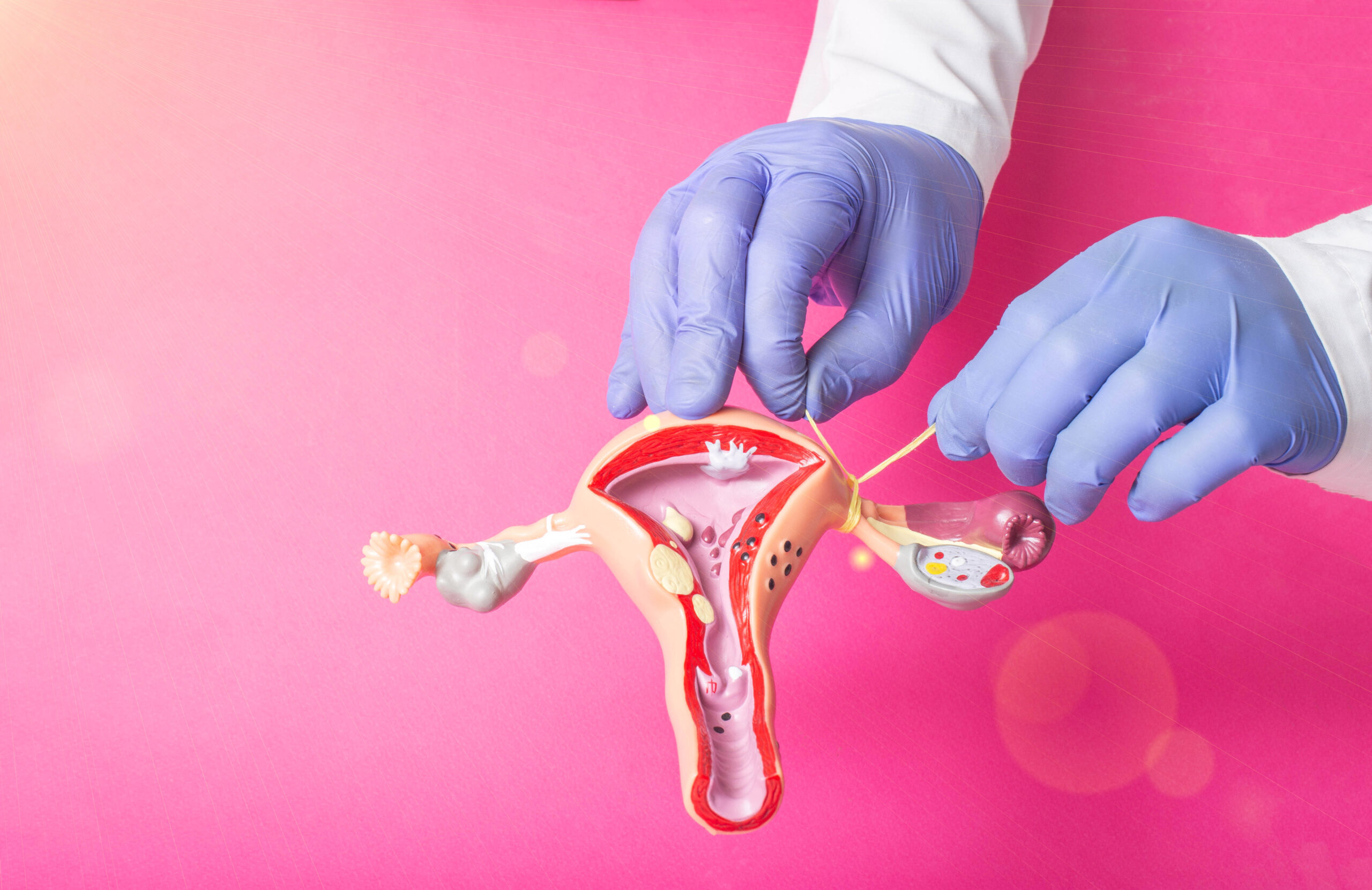 Doctor gynecologist ligates the fallopian tubes on the example of the layout of the female reproductive system, pink background. Contraception concept for unwanted pregnancy, copy space for text, procedure