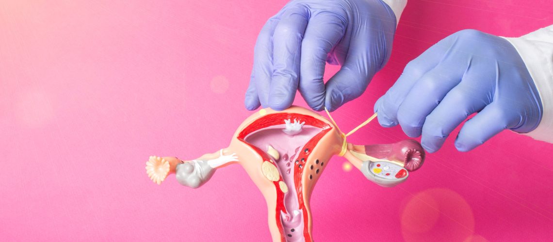 Doctor gynecologist ligates the fallopian tubes on the example of the layout of the female reproductive system, pink background. Contraception concept for unwanted pregnancy, copy space for text, procedure
