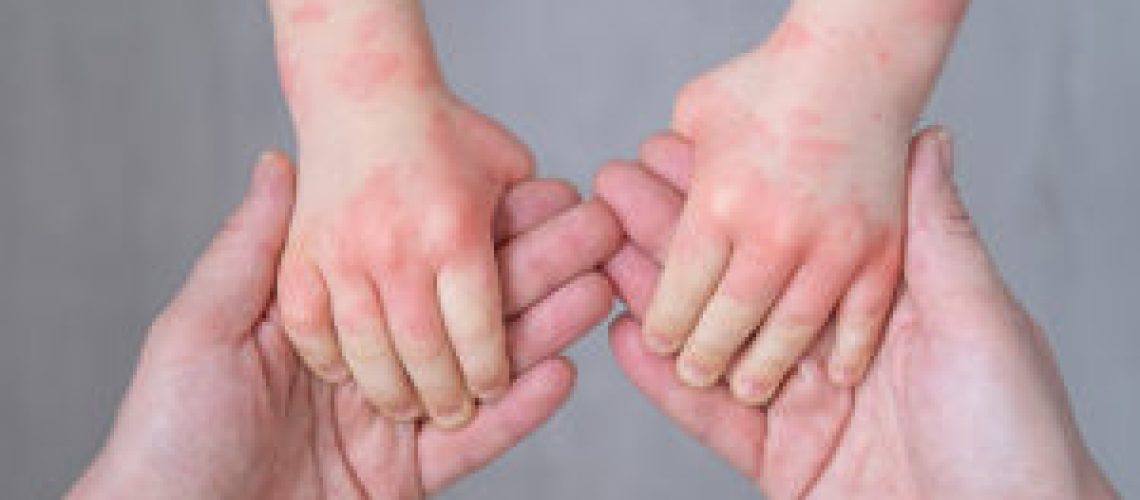 close up mother holding kids hands with allergic rash or eczema. severe allergic reaction, atopic skin.
